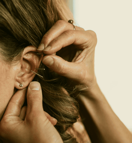 Acupuncture treatment